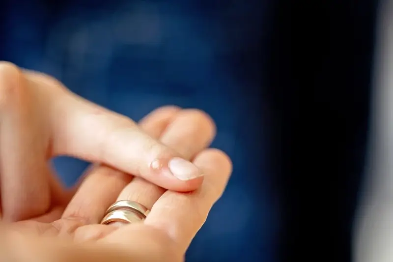 Co dobrego na kurzajki?